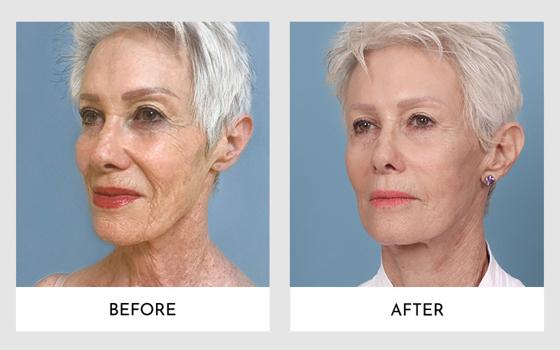 Mini Facelift and Full Facelift Insights from a Plastic Surgeon Aesthetic MdR Marina del Rey