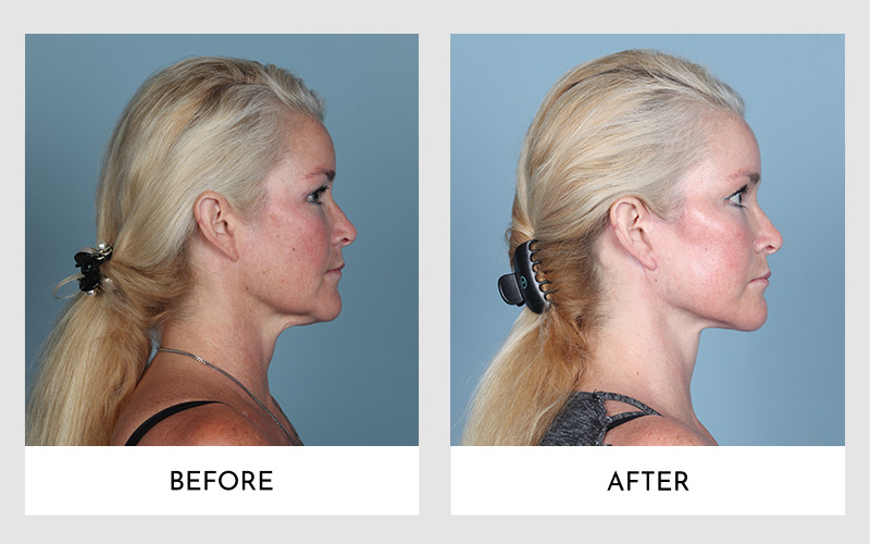 Side profile comparison showcasing a facelift's impact on a blonde woman.