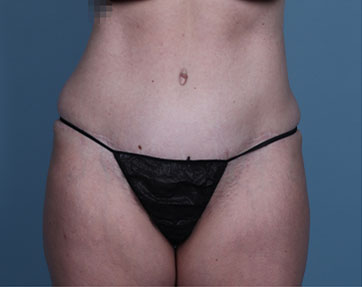 Tummy Tuck Marina Del Rey