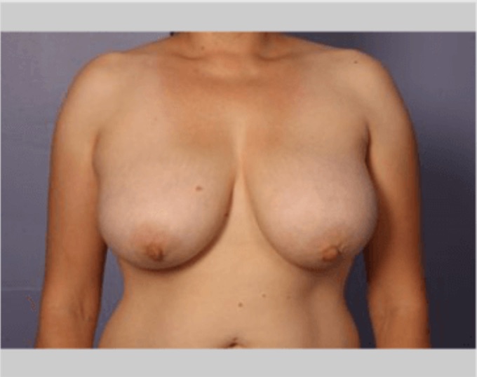 Breast Reduction Marina Del Rey