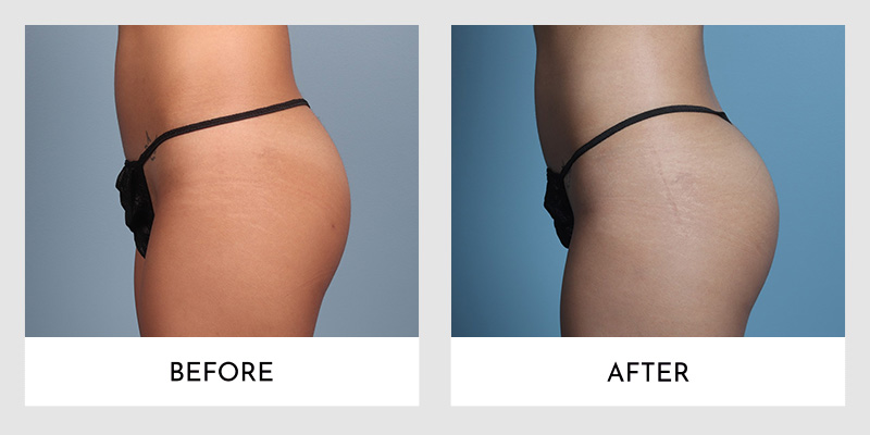 Brazilian Butt Lift Before and After | Aesthetic MdR