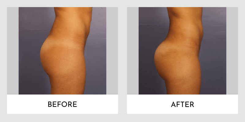 Brazilian Butt Lift Before and After | Aesthetic MdR