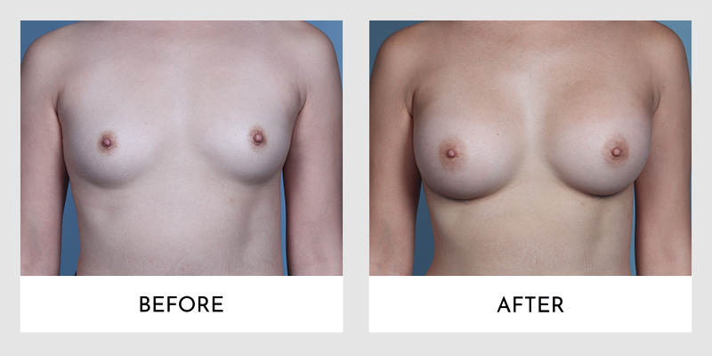 Breast Augmentation Before and After | Aesthetic MdR