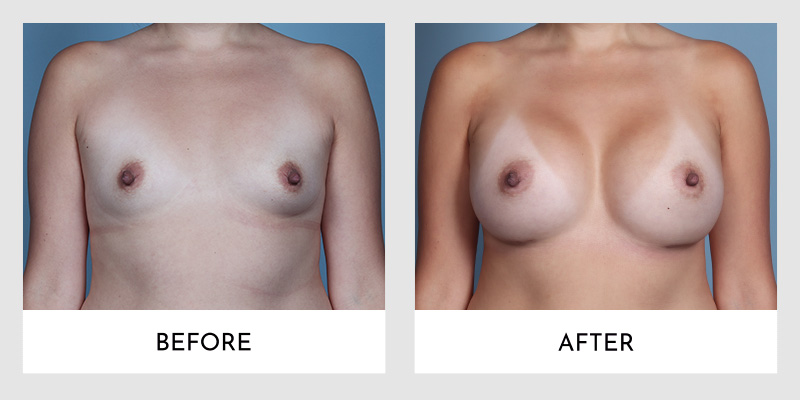 Breast Augmentation Before and After | Aesthetic MdR