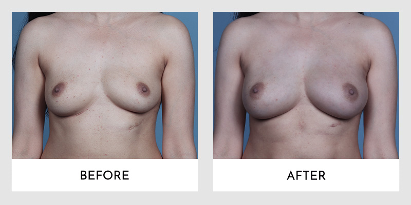 Breast Augmentation Before and After | Aesthetic MdR