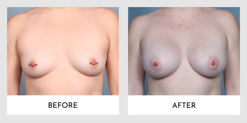 Breast Augmentation Before and After | Aesthetic MdR