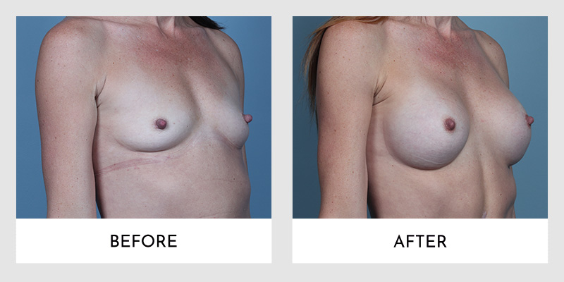 Breast Augmentation Before and After | Aesthetic MdR