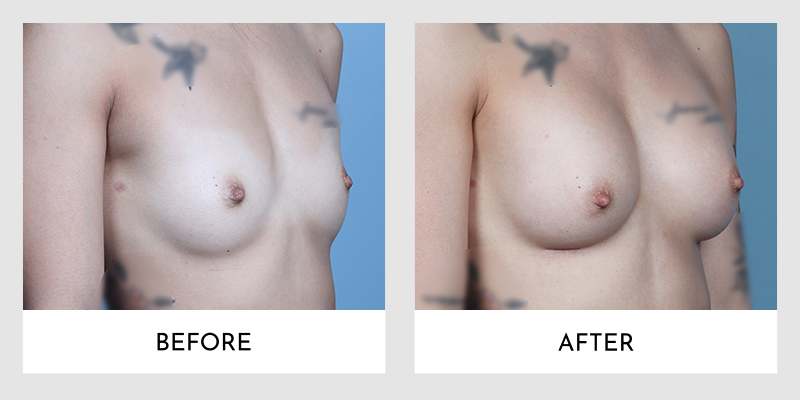 Breast Augmentation Before and After | Aesthetic MdR