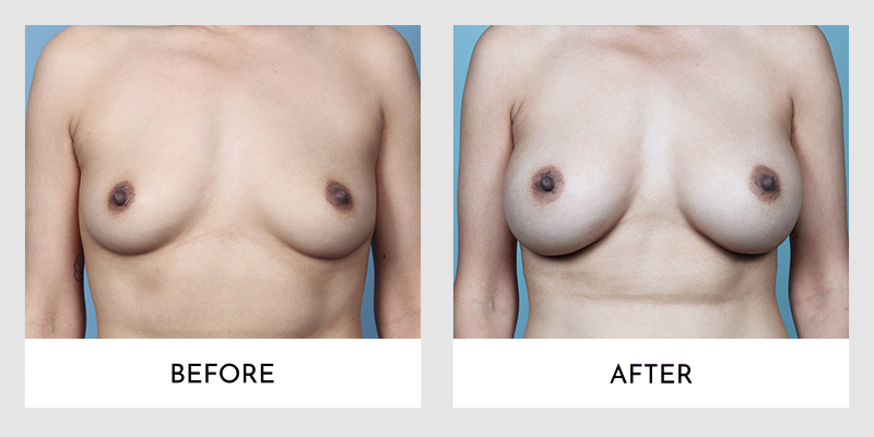 Breast Augmentation Before and After | Aesthetic MdR