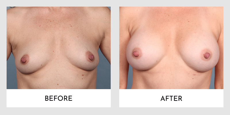 Breast Augmentation Before and After | Aesthetic MdR