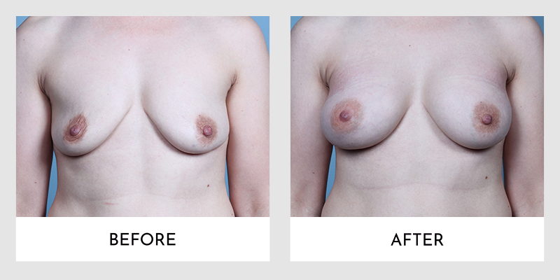 Breast Augmentation Before and After | Aesthetic MdR