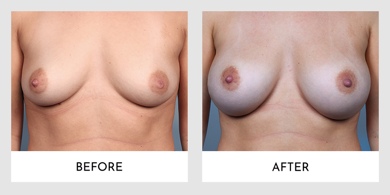 Breast Augmentation Before and After | Aesthetic MdR