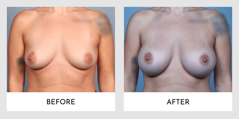 Breast Augmentation Before and After | Aesthetic MdR
