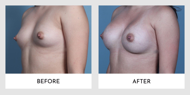 Breast Augmentation Before and After | Aesthetic MdR