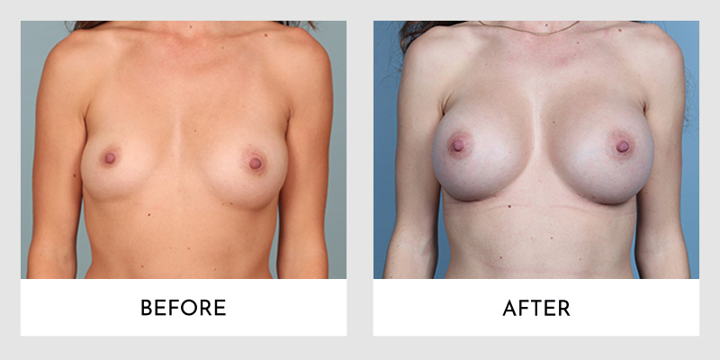 Breast Augmentation Before and After | Aesthetic MdR