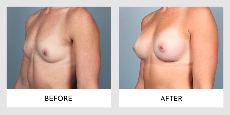 Breast Augmentation Before and After | Aesthetic MdR