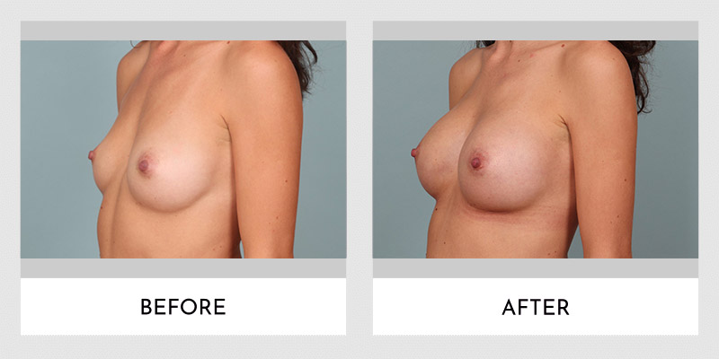 Breast Augmentation Before and After | Aesthetic MdR