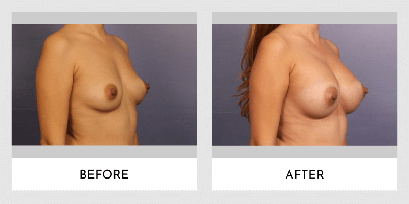 Breast Augmentation Before and After | Aesthetic MdR