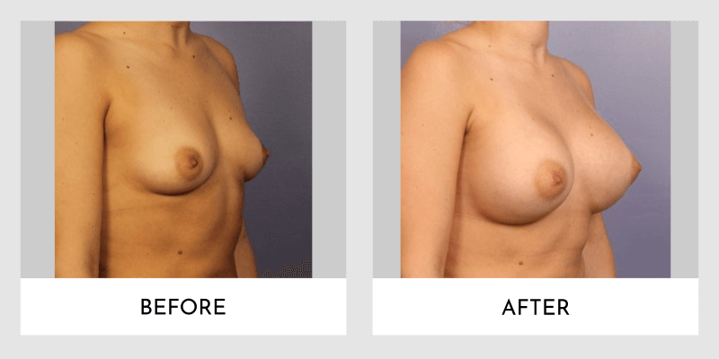 Breast Augmentation Before and After | Aesthetic MdR