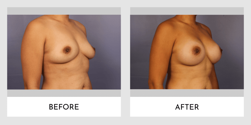 Breast Augmentation Before and After | Aesthetic MdR