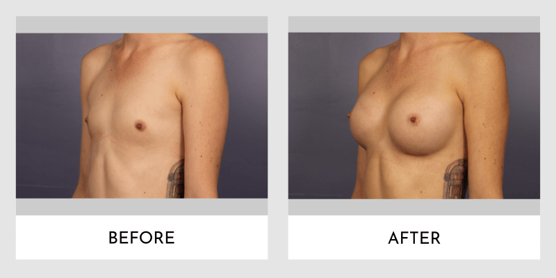 Breast Augmentation Before and After | Aesthetic MdR