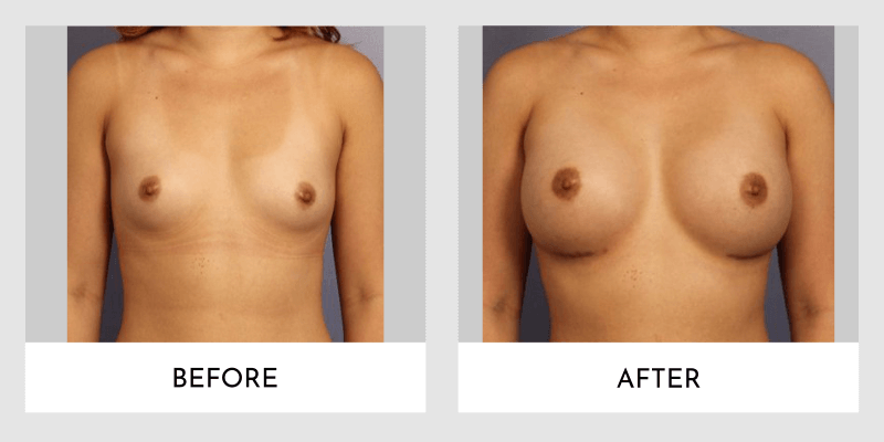 Breast Augmentation Before and After | Aesthetic MdR