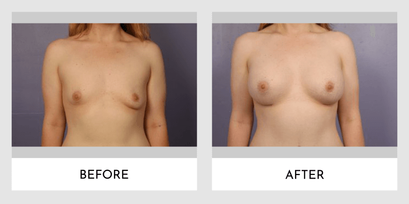 Breast Augmentation Before and After | Aesthetic MdR