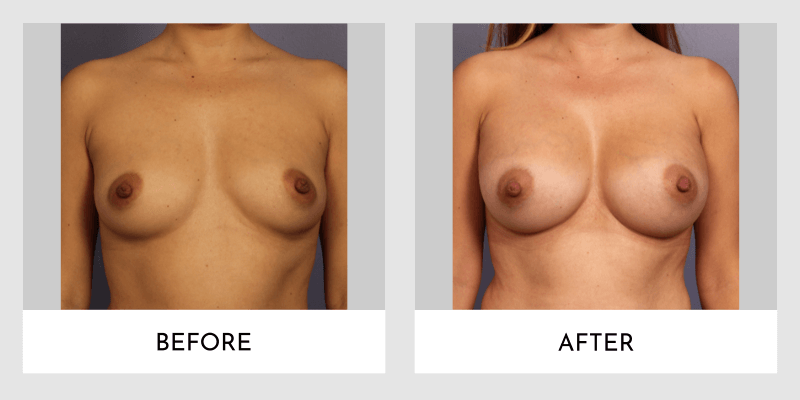 Breast Augmentation Before and After | Aesthetic MdR