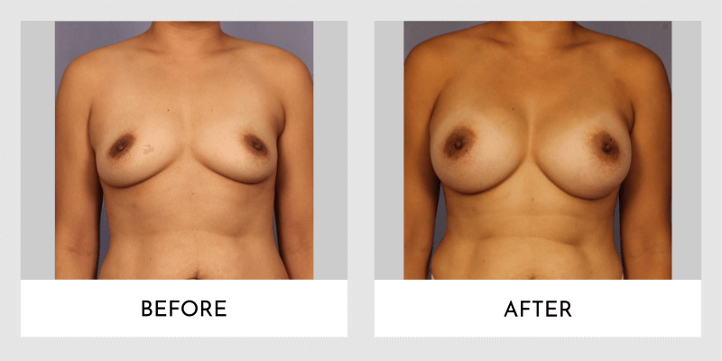 Breast Augmentation Before and After | Aesthetic MdR