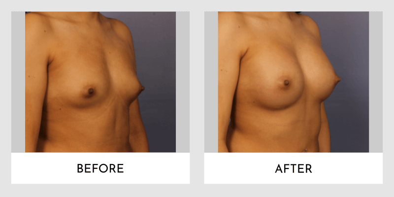 Breast Augmentation Before and After | Aesthetic MdR