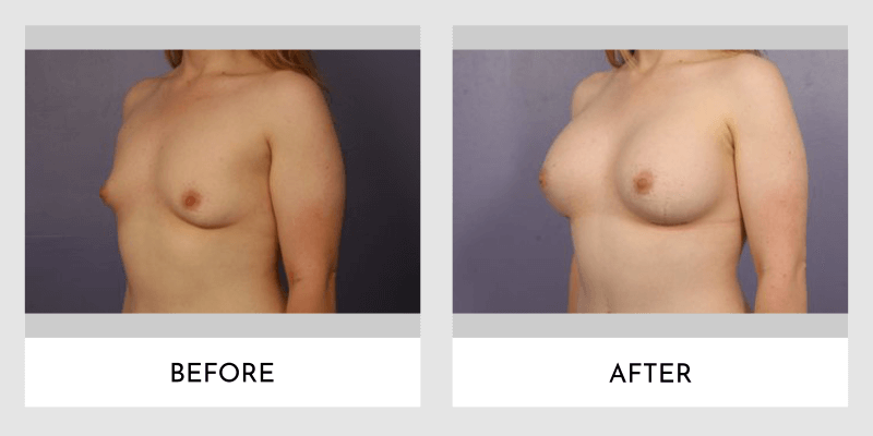 Breast Augmentation Before and After | Aesthetic MdR