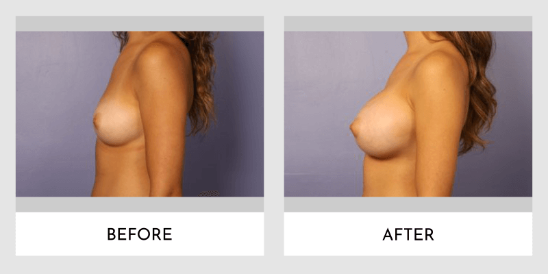 Breast Augmentation Before and After | Aesthetic MdR