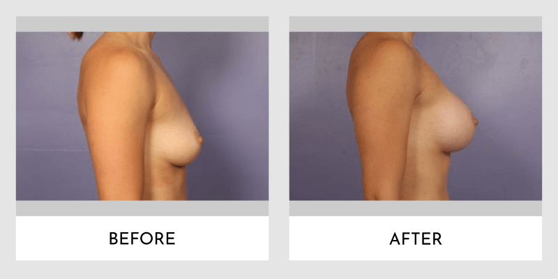 Breast Augmentation Before and After | Aesthetic MdR