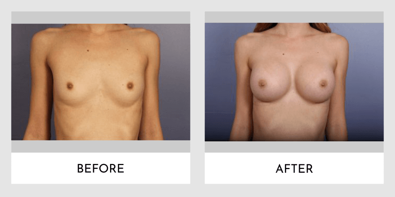 Breast Augmentation Before and After | Aesthetic MdR