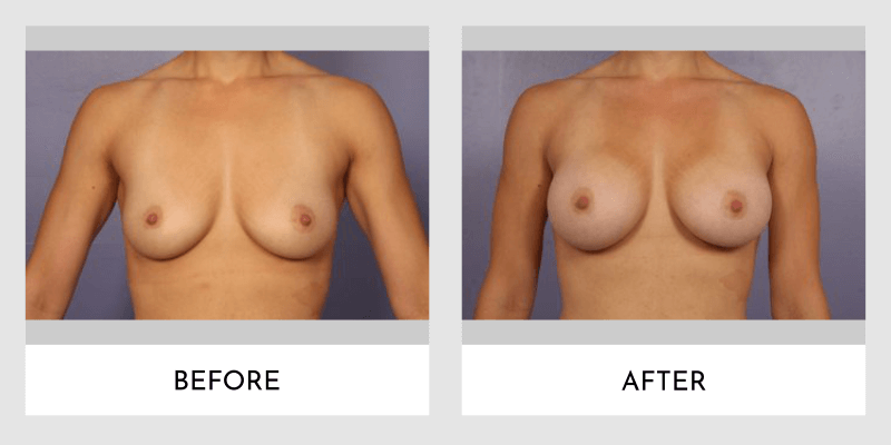 Breast Augmentation Before and After | Aesthetic MdR