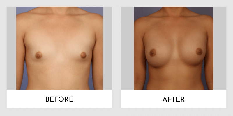 Breast Augmentation Before and After | Aesthetic MdR