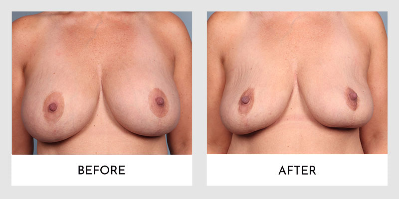 Breast Explant Before and After | Aesthetic MdR
