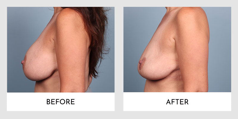 Breast Explant Before and After | Aesthetic MdR