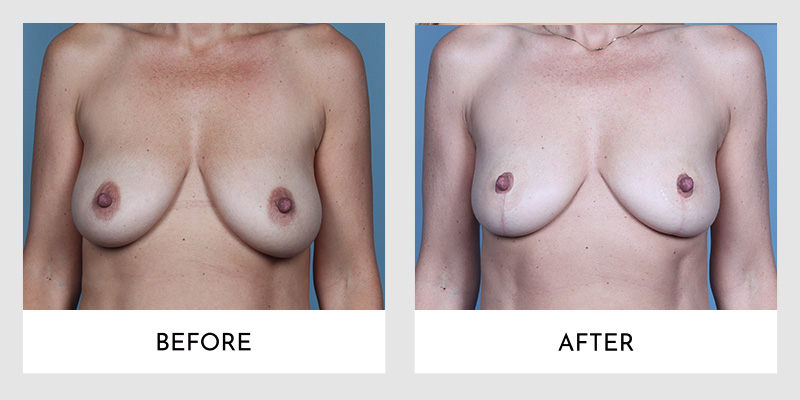 Breast Lift Before and After | Aesthetic MdR