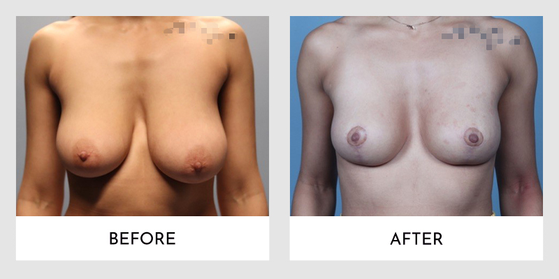 Breast Lift Before and After | Aesthetic MdR