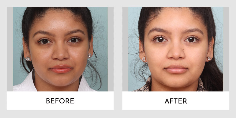 Buccal Fat Pad Removal Before and After | Aesthetic MdR