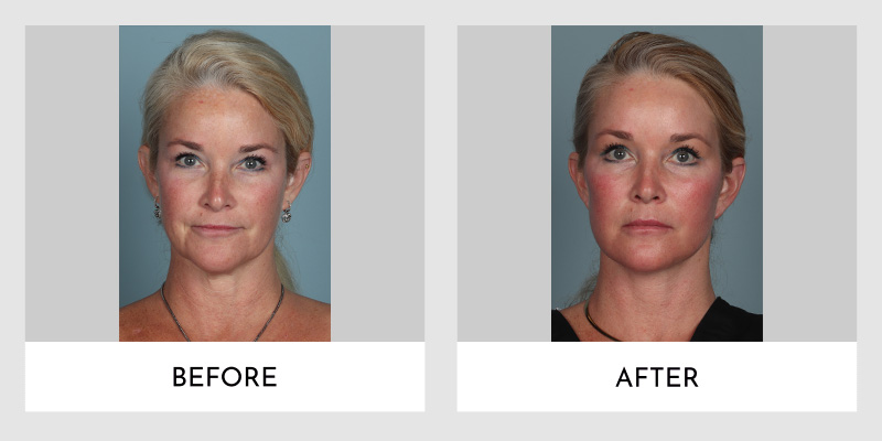 Facelift Before and After | Aesthetic MdR