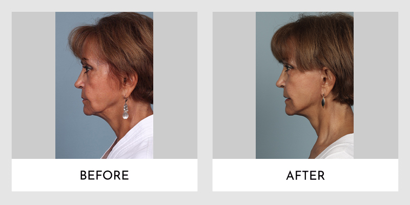 Facelift Before and After | Aesthetic MdR