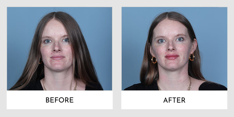 Fillers Before and After | Aesthetic MdR