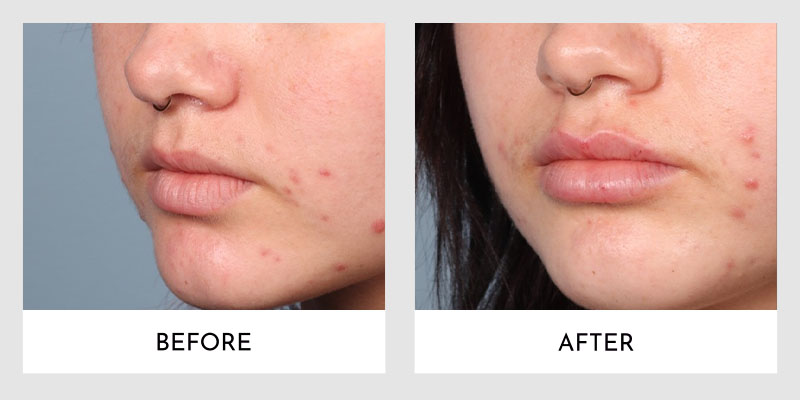 Fillers Before and After | Aesthetic MdR