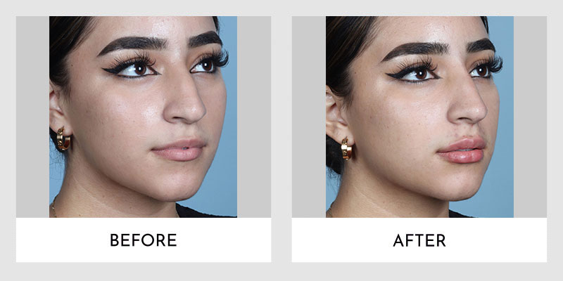 Fillers Before and After | Aesthetic MdR