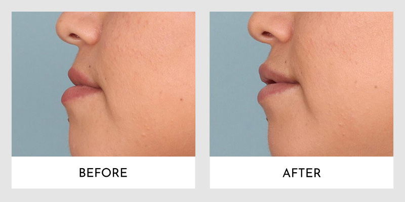 Fillers Before and After | Aesthetic MdR