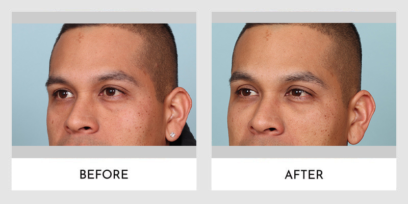 Fillers Before and After | Aesthetic MdR