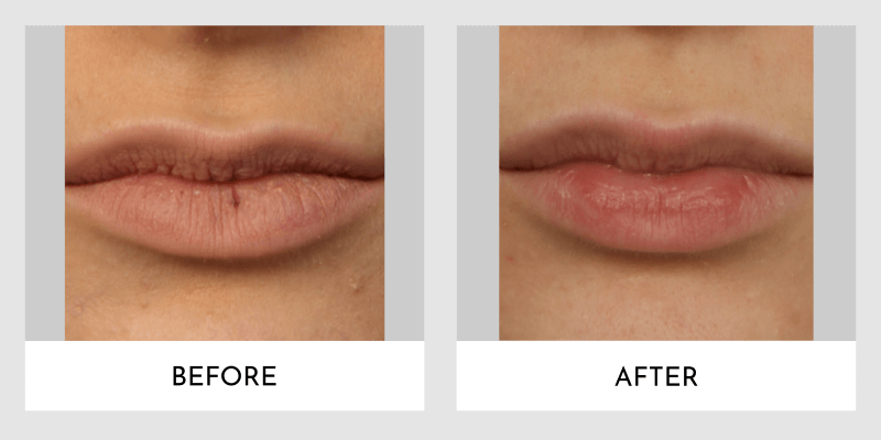 Fillers Before and After | Aesthetic MdR