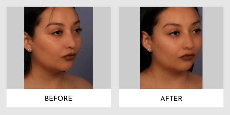 Fillers Before and After | Aesthetic MdR